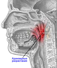 Аденоиды